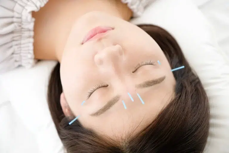 The Ultimate Guide to Facial Acupuncture: Skin Benefits, Cost, and Side Effects Explained