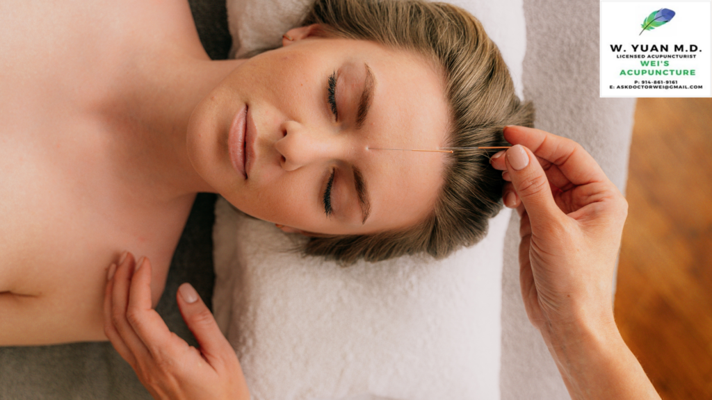 acupuncture for migraines in Grand Central Terminal NY