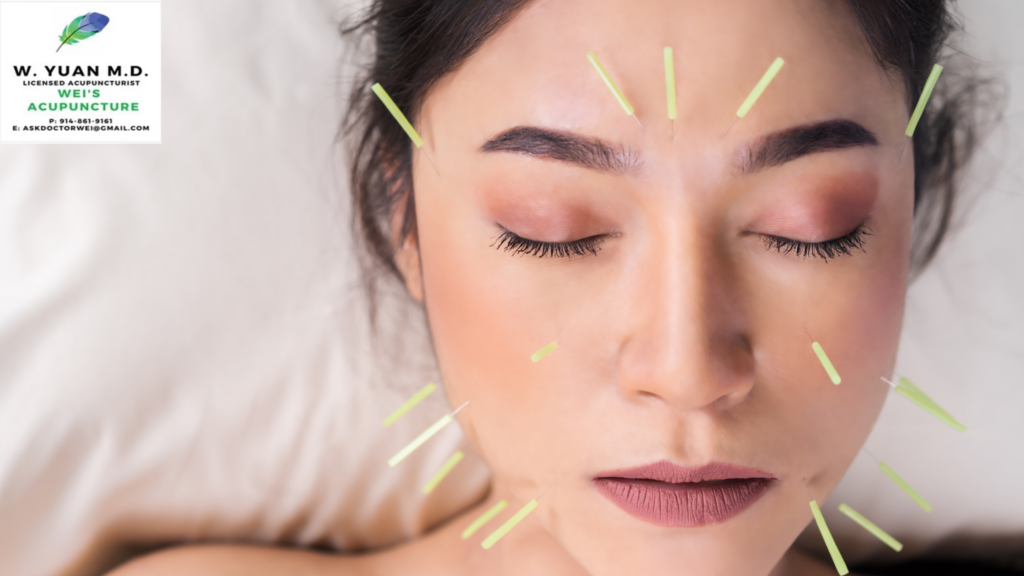 Acupuncture For insomnia Westchester NY