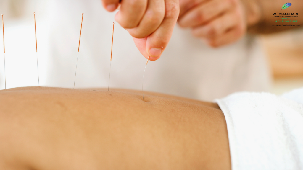 Acupuncture for Lower Back Pain in Westchester NY