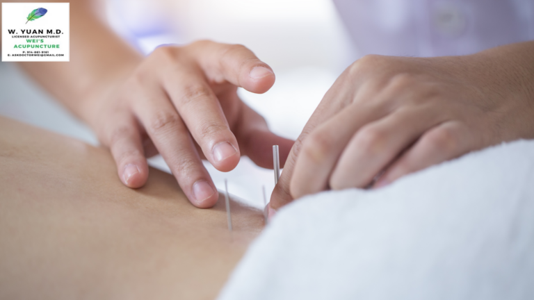 Acupuncture in New York